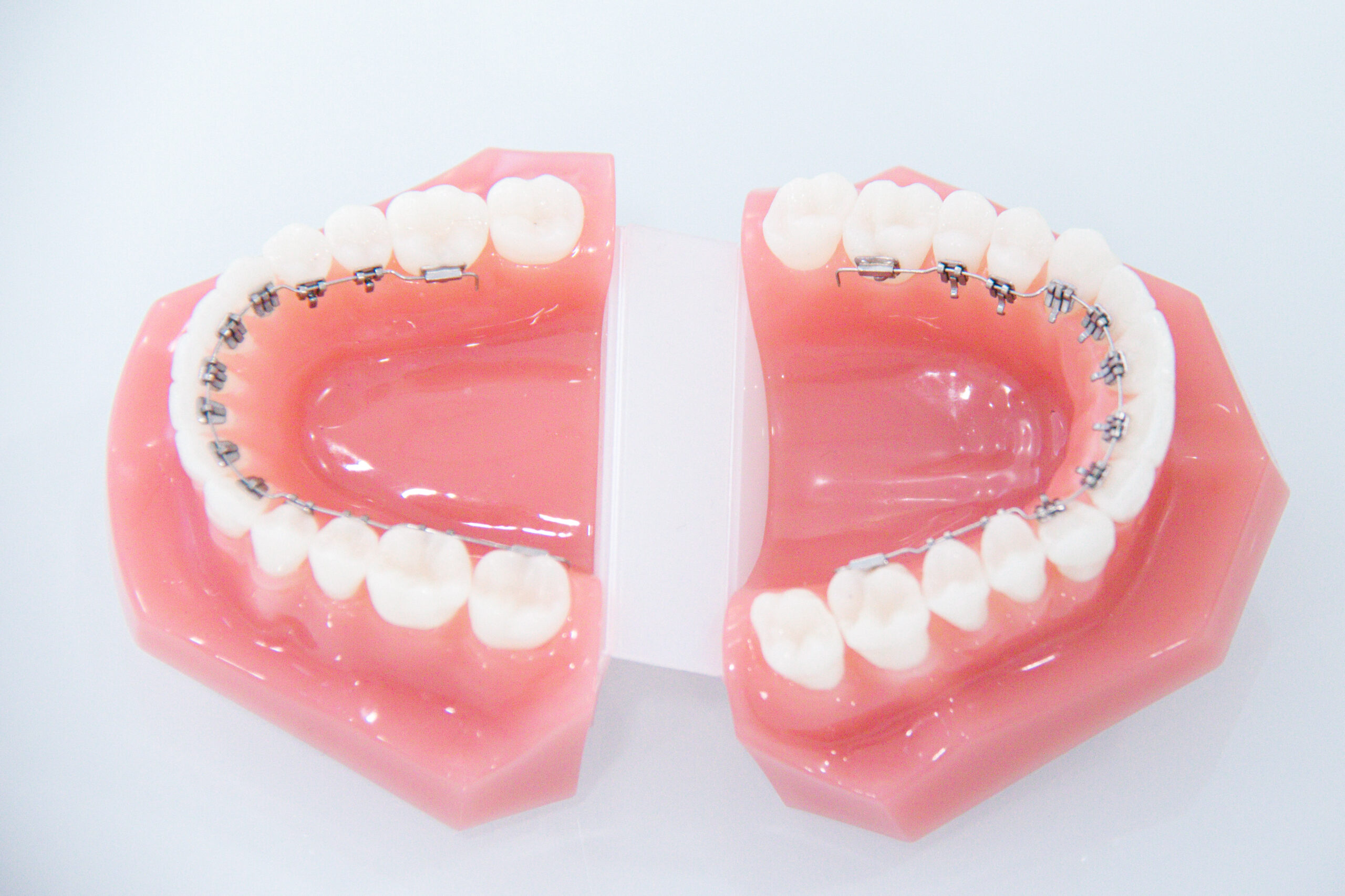 aparelho fixo lingual