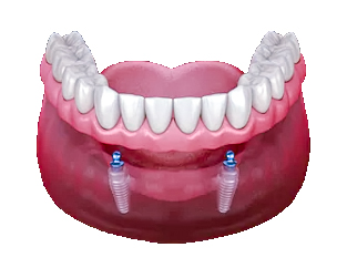all in four - implante dentário