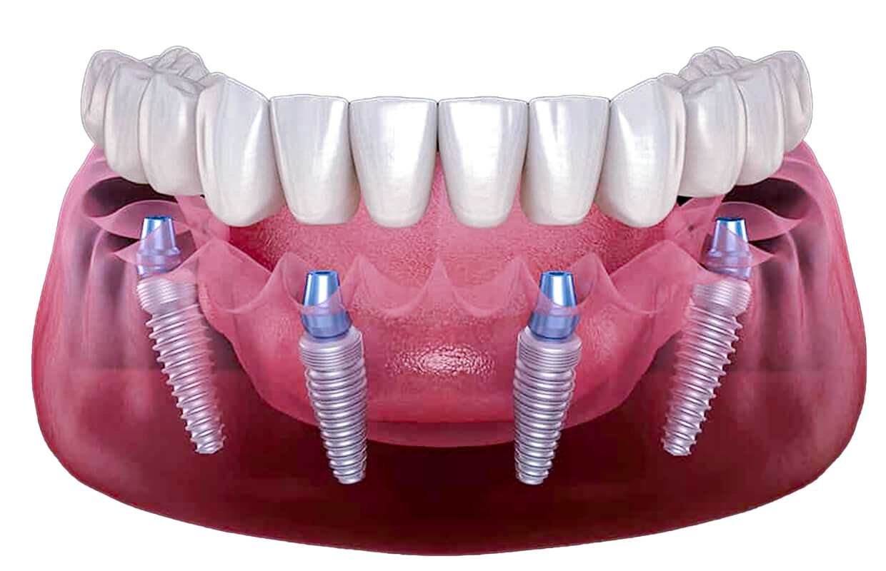 all on six - implante dentário