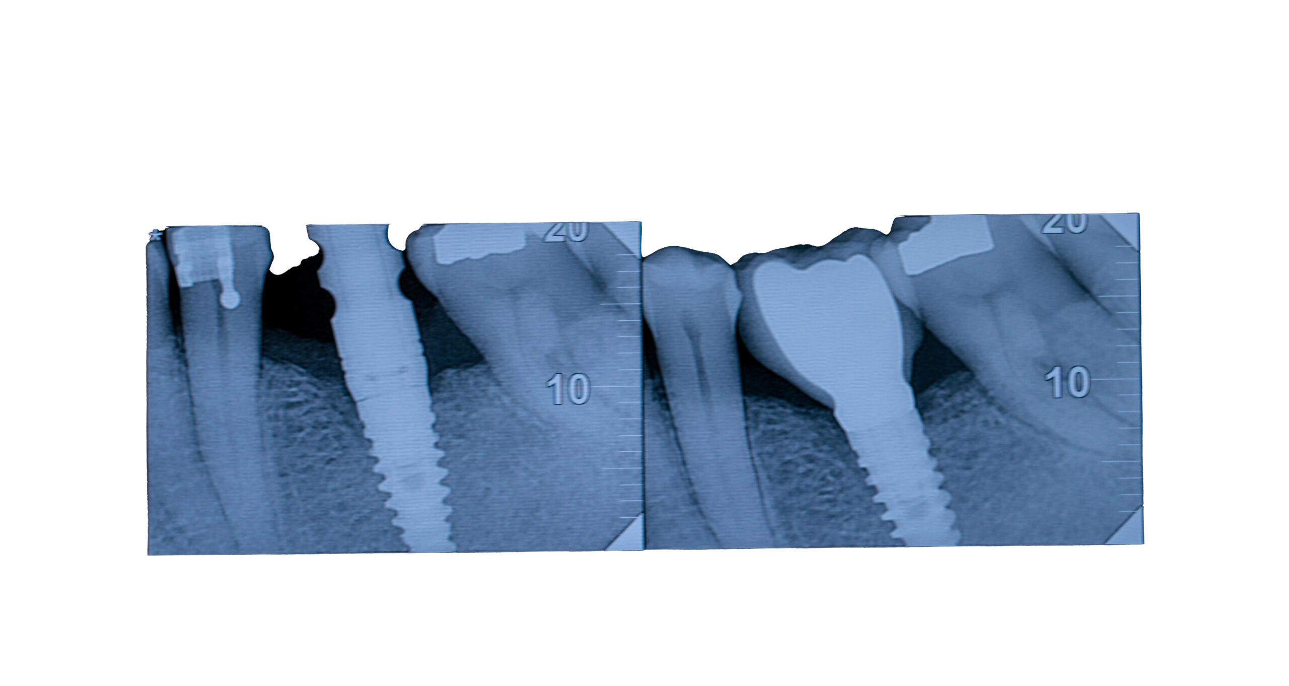raio x implantes